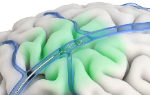 陈天桥早于马斯克布局脑机接口 投资Synchron引领意念操控时代(图3)